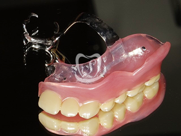 インプラント併用義歯