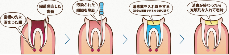 根管治療の流れ