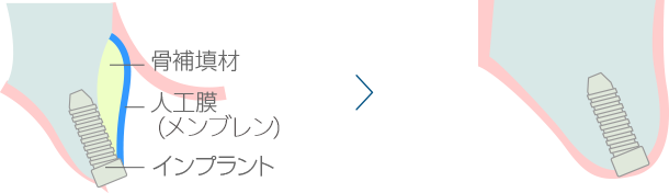 GBR法（骨誘導再生治療）