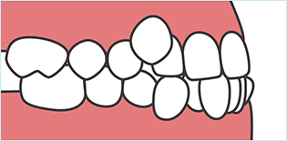 叢生/八重歯・乱杭歯