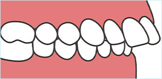 上顎前突/出っ歯