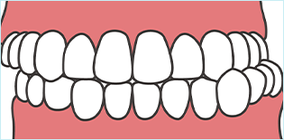 交叉咬合/横ずれ咬合