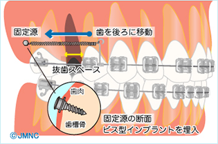 ミニインプラントを用いた矯正