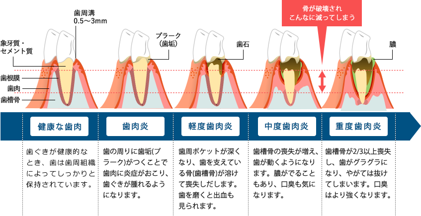 歯周病の症状と進行の様子