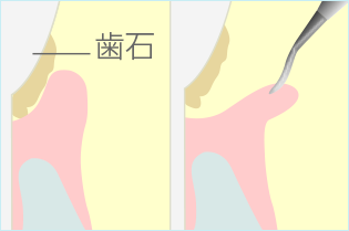 歯周ポケット掻爬術（外科治療）